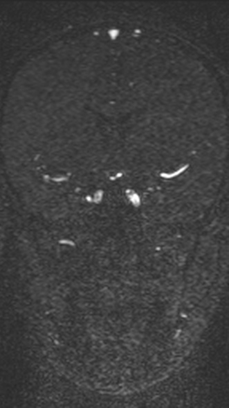 Normal MRI brain with MRV- teenager (Radiopaedia 49425-54553 Coronal MRV 108).jpg