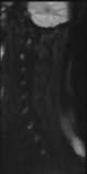 File:Normal MRI cervical spine (infection protocol) (Radiopaedia 53916-60039 Sagittal DWI 17).png