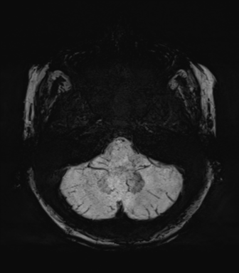 Normal MRI internal auditory canal (Radiopaedia 41613-44525 Axial SWI MIP 14).png