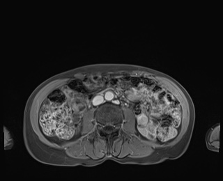 Normal adrenal glands MRI (Radiopaedia 82017-96004 M 57).jpg