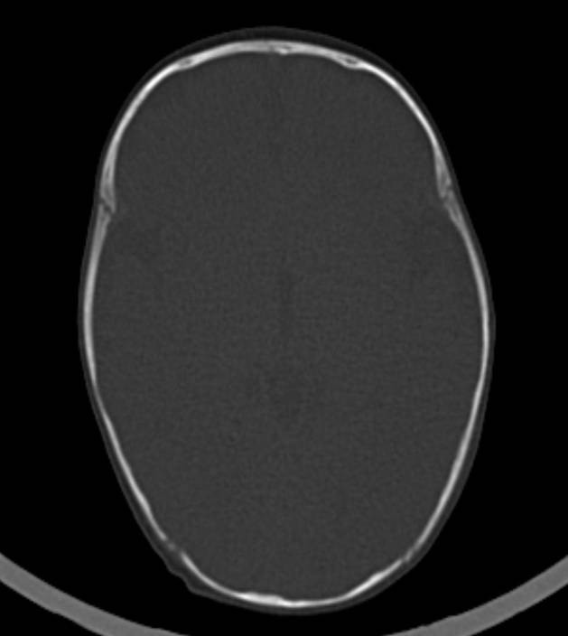 Normal brain CT - 2-month-old (Radiopaedia 53369-59350 Axial bone window 33).jpg