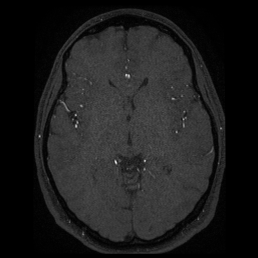 Normal brain MRA (Radiopaedia 41046-43793 Axial MRA 29).png