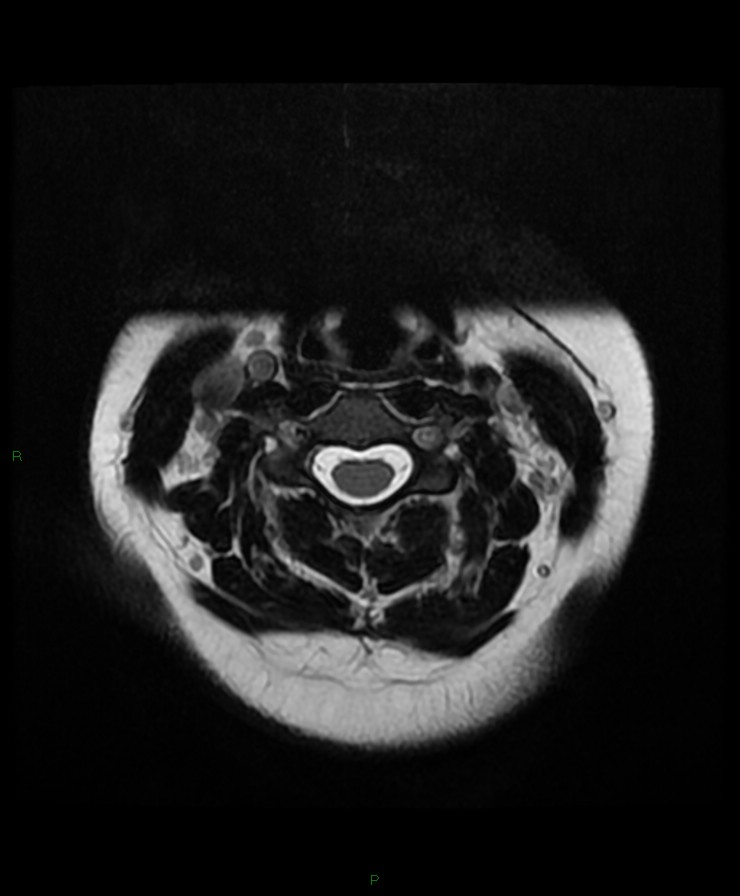 Normal cervical spine MRI (Radiopaedia 80146-93454 Axial T2 35).jpg