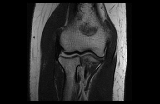File:Normal elbow arthrograms (Radiopaedia 75550-86805 Coronal T1 9).jpg
