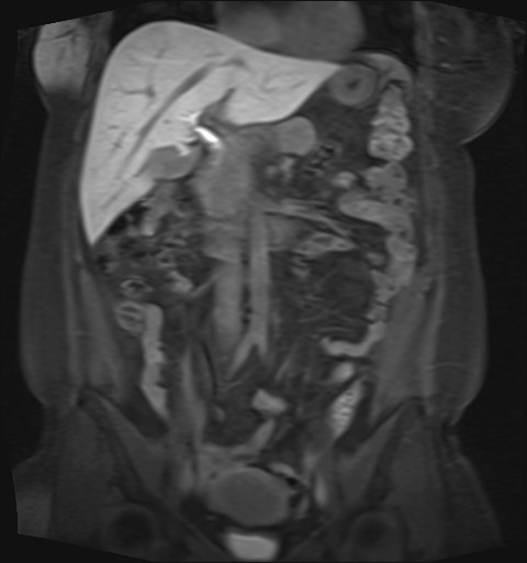 File:Normal hepatobiliary phase liver MRI (Radiopaedia 58968-66230 B 31).jpg
