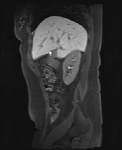 File:Normal hepatobiliary phase liver MRI (Radiopaedia 58968-66230 C 22).jpg