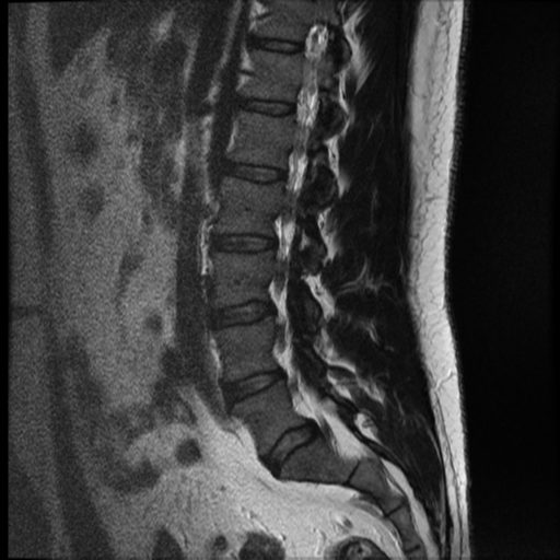 File:Normal lumbar spine MRI (Radiopaedia 35543-37039 Sagittal T2 9).png