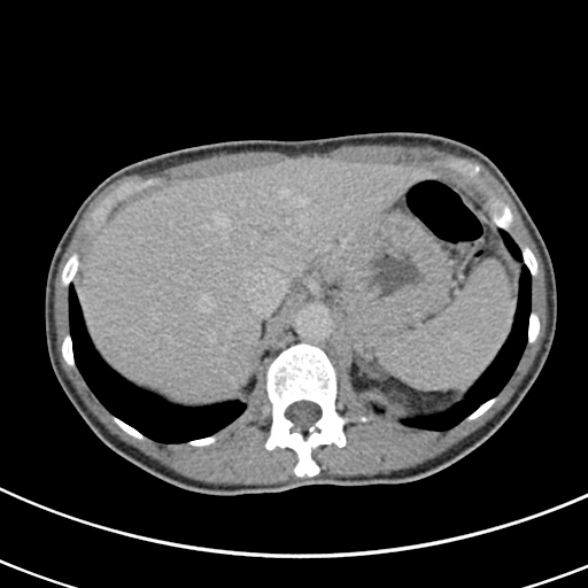 File:Normal multiphase CT liver (Radiopaedia 38026-39996 Axial C+ delayed 15).jpg