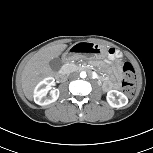 File:Normal multiphase CT liver (Radiopaedia 38026-39996 B 40).jpg