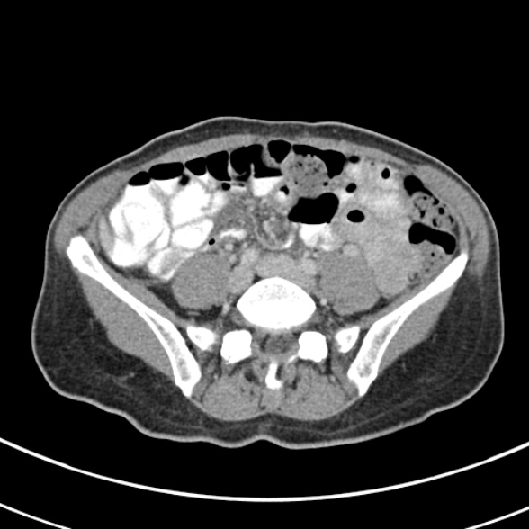File:Normal multiphase CT liver (Radiopaedia 38026-39996 C 60).jpg