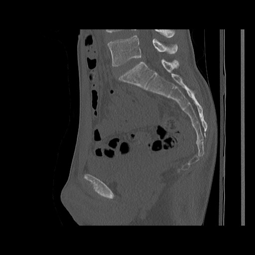 Normal pelvis (Radiopaedia 51473-57238 Sagittal bone window 78).jpg