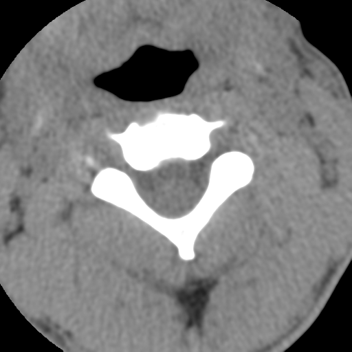 Normal trauma cervical spine (Radiopaedia 41017-43760 Axial non-contrast 22).png