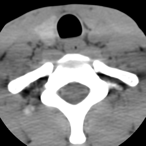 Normal trauma cervical spine (Radiopaedia 41017-43760 Axial non-contrast 51).png
