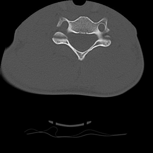 File:Normal trauma spine imaging (age 16) (Radiopaedia 45335-49358 Axial bone window 55).jpg
