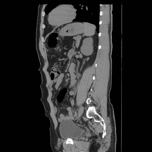 File:Obstructed kidney with perinephric urinoma (Radiopaedia 26889-27066 B 45).jpg