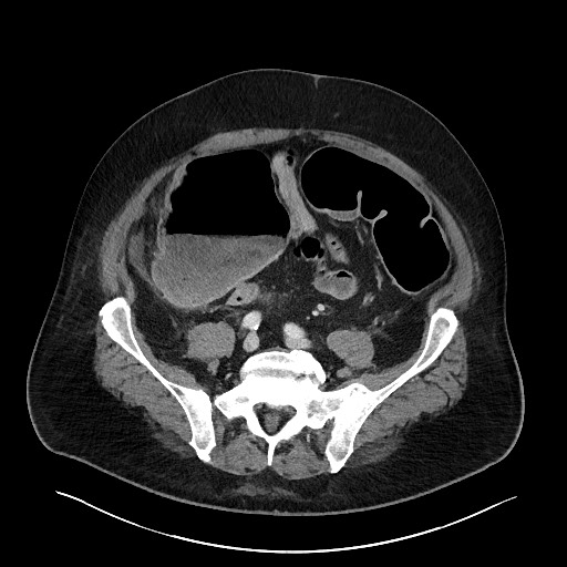 Obstructing sigmoid adenocarcinoma (Radiopaedia 58465-65619 A 117).jpg