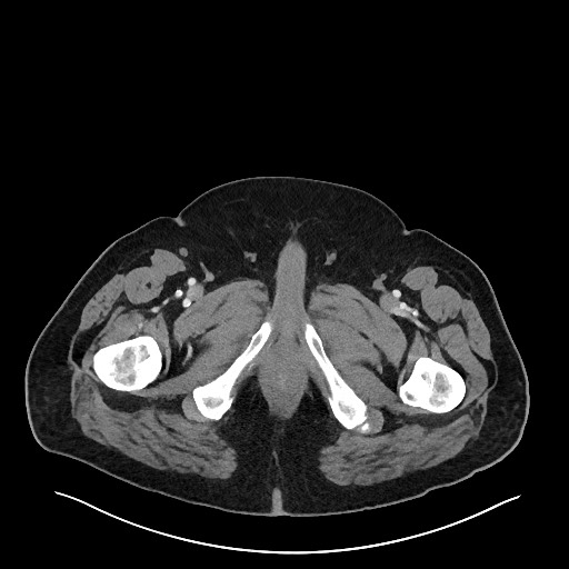 Obstructing sigmoid adenocarcinoma (Radiopaedia 58465-65619 A 173).jpg