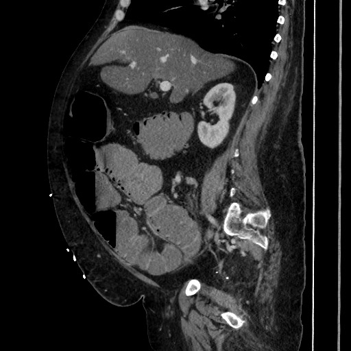 Obstructive colonic diverticular stricture (Radiopaedia 81085-94675 C 101).jpg