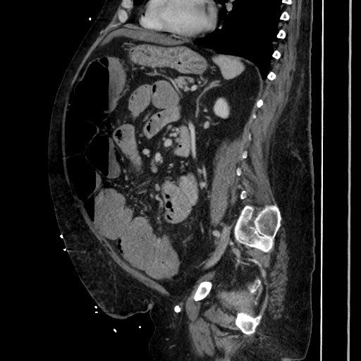 Obstructive colonic diverticular stricture (Radiopaedia 81085-94675 C 146).jpg