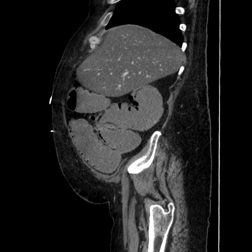 Obstructive colonic diverticular stricture (Radiopaedia 81085-94675 C 61).jpg