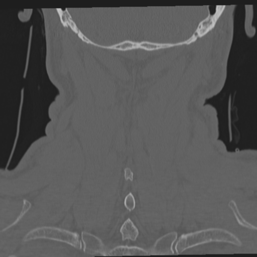 File:Occipital condyle fracture (Radiopaedia 33467-34517 Coronal bone window 58).png