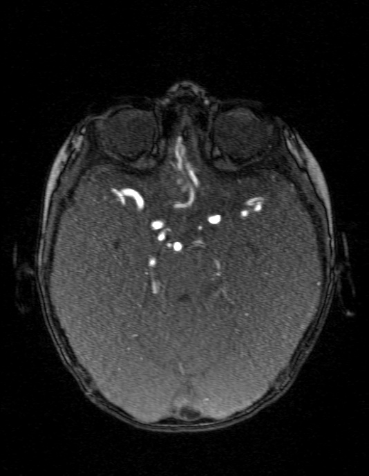 Occipital horn syndrome (Radiopaedia 14255-14129 MRA 58).jpg