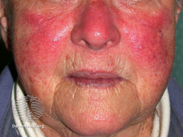 Rosacea (DermNet NZ acne-red-face-3633).jpg