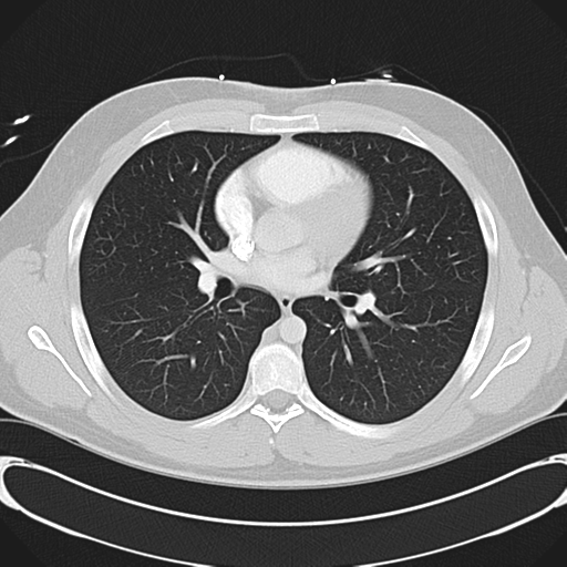 File:'Bovine' aortic arch (Radiopaedia 33554-34637 Axial lung window 31).png