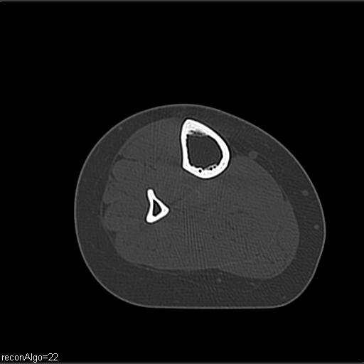 File:ACL avulsion fracture (Radiopaedia 33833-34994 Axial bone window 41).jpg