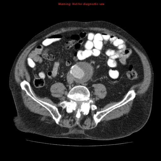 File:Abdominal aortic aneurysm (Radiopaedia 10122-10660 Axial C+ portal venous phase 52).jpg