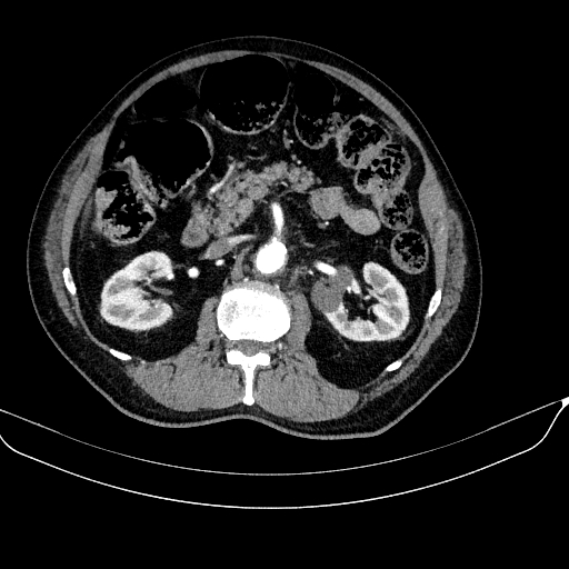 Abdominal aortic aneurysm (Radiopaedia 67117-76452 Axial C+ arterial phase 56).jpg