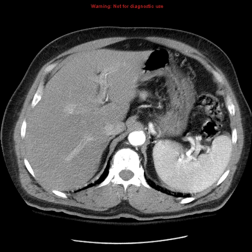 Abdominal aortic aneurysm (Radiopaedia 8190-9038 Axial C+ arterial phase 21).jpg