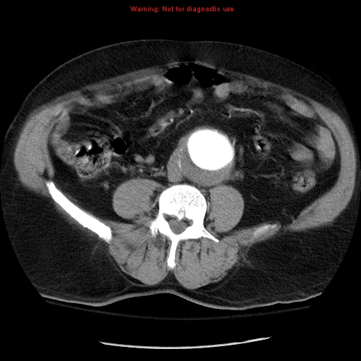 Abdominal aortic aneurysm (Radiopaedia 8190-9038 Axial C+ arterial phase 50).jpg