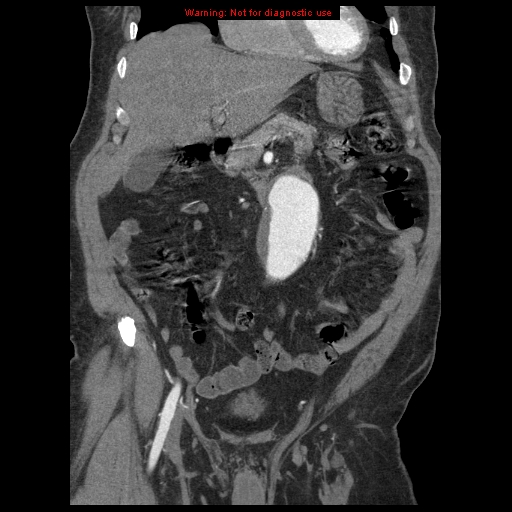 File:Abdominal aortic aneurysm (Radiopaedia 8190-9038 Coronal C+ arterial phase 42).jpg