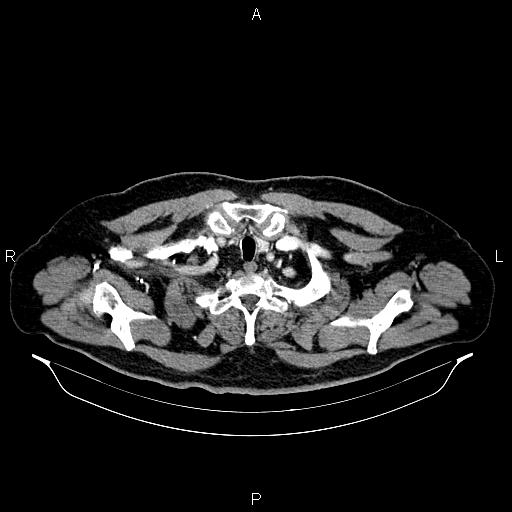 Abdominal aortic aneurysm (Radiopaedia 83094-97462 Axial renal cortical phase 8).jpg