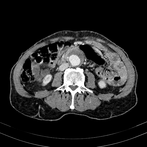 Abdominal aortic aneurysm (Radiopaedia 83581-98689 Axial C+ portal venous phase 62).jpg