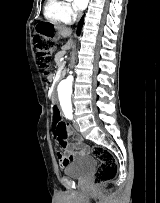 Abdominal aortic aneurysm (Radiopaedia 83581-98689 Sagittal C+ arterial phase 43).jpg