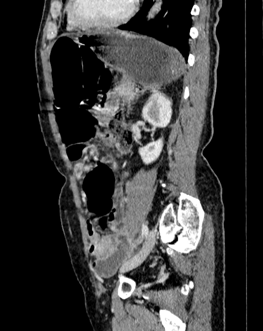 Abdominal aortic aneurysm (Radiopaedia 83581-98689 Sagittal C+ portal venous phase 86).jpg