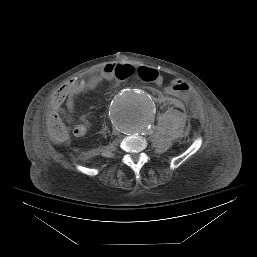 Abdominal aortic aneurysm - impending rupture (Radiopaedia 19233-19247 Axial non-contrast 104).jpg