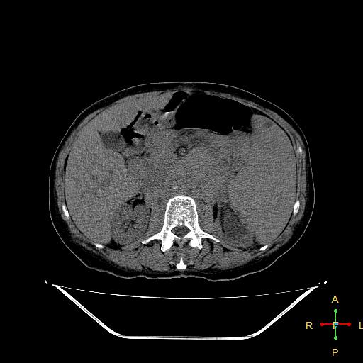 File:Abdominal lymphoma (Radiopaedia 23085-23115 Axial non-contrast 9).jpg