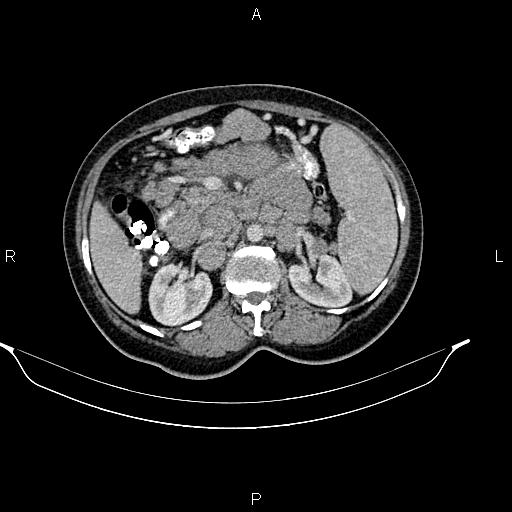 Abdominal lymphoma with sandwich sign (Radiopaedia 84378-99704 Axial C+ portal venous phase 23).jpg