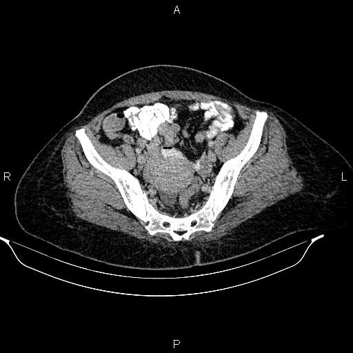 File:Abdominal lymphoma with sandwich sign (Radiopaedia 84378-99704 Axial C+ portal venous phase 47).jpg