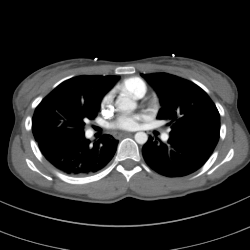 File:Abdominal multi-trauma - devascularised kidney and liver, spleen and pancreatic lacerations (Radiopaedia 34984-36486 Axial C+ arterial phase 43).png