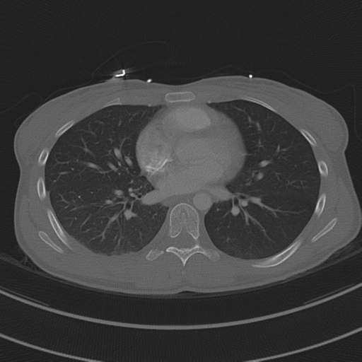 File:Abdominal multi-trauma - devascularised kidney and liver, spleen and pancreatic lacerations (Radiopaedia 34984-36486 I 49).png