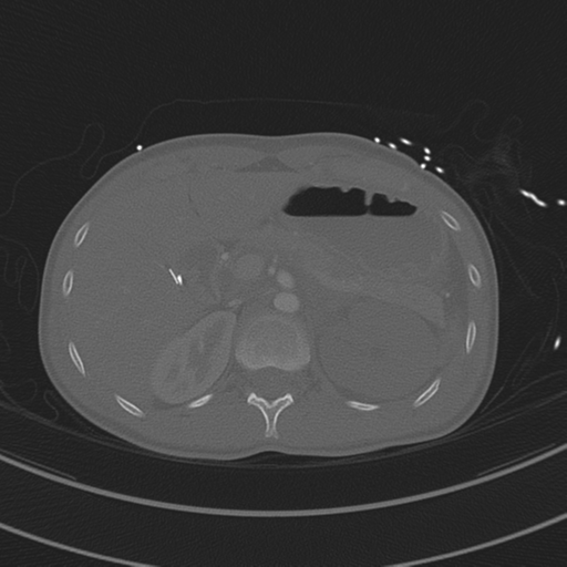 File:Abdominal multi-trauma - devascularised kidney and liver, spleen and pancreatic lacerations (Radiopaedia 34984-36486 I 96).png