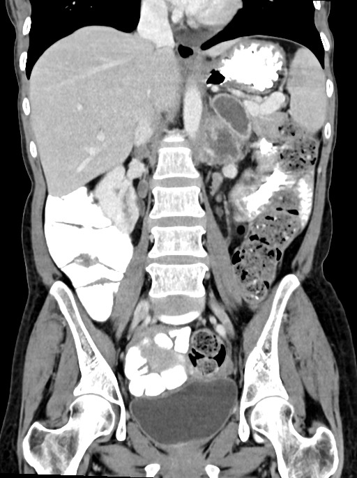 Abdominal wall and retroperitoneal tuberculosis (Radiopaedia 88137-104729 Coronal C+ portal venous phase 56).jpg