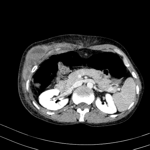 File:Abdominal wall hematoma with active bleeding (Radiopaedia 83915-99117 Axial C+ portal venous phase 16).jpg
