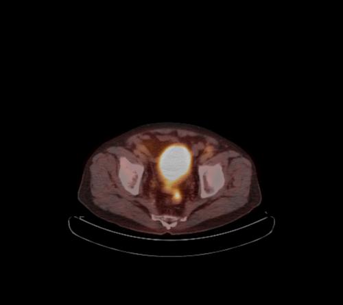 Abdominal wall metastasis from colorectal carcinoma (Radiopaedia 31016-31719 C 31).jpg
