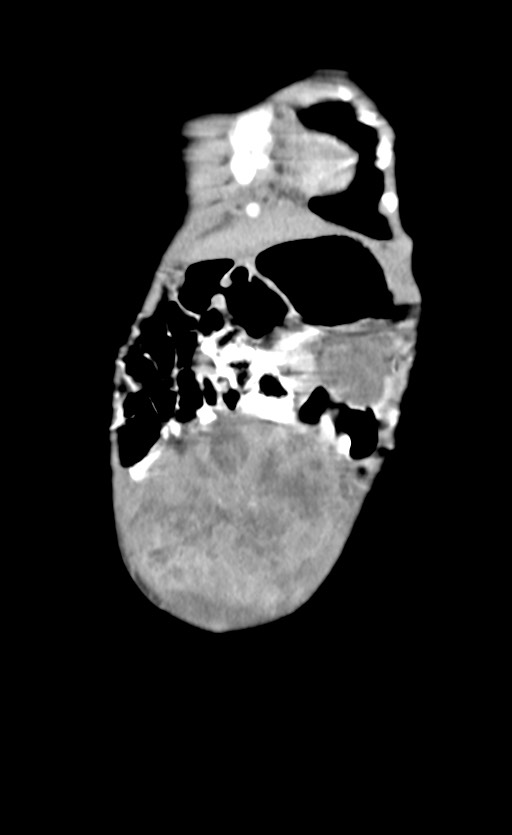 Abdominopelvic rhabdomyosarcoma (Radiopaedia 78356-90984 Coronal C+ portal venous phase 12).jpg