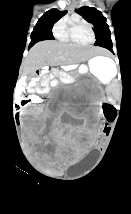Abdominopelvic rhabdomyosarcoma (Radiopaedia 78356-90984 Coronal C+ portal venous phase 30).jpg